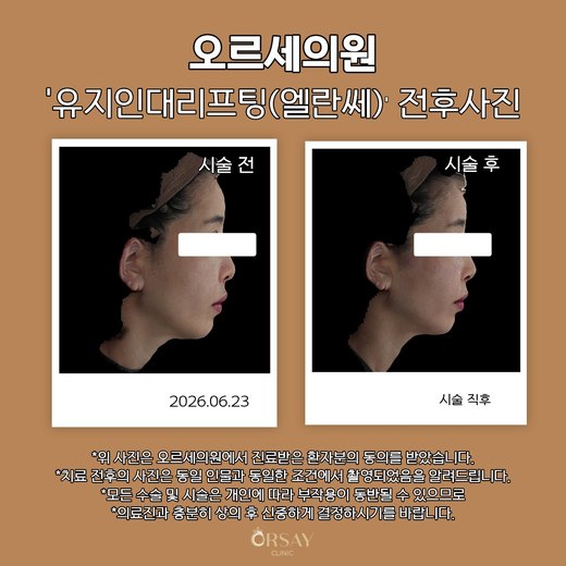유지인대리프팅(엘란쎄) 전후사진 2026.06.23