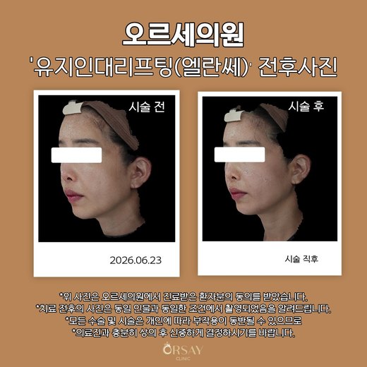 유지인대리프팅(엘란쎄) 전후사진 2026.06.23
