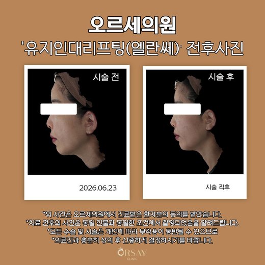 유지인대리프팅(엘란쎄) 전후사진 2026.06.23