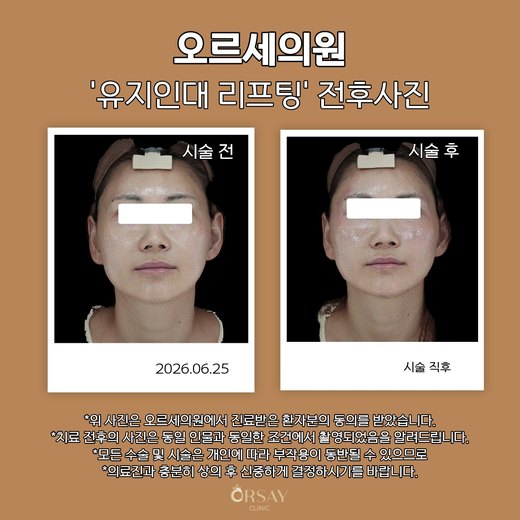 유지인대 리프팅 전후사진 정면