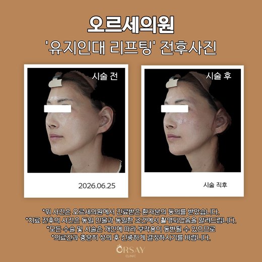 유지인대 리프팅 전후사진 45도
