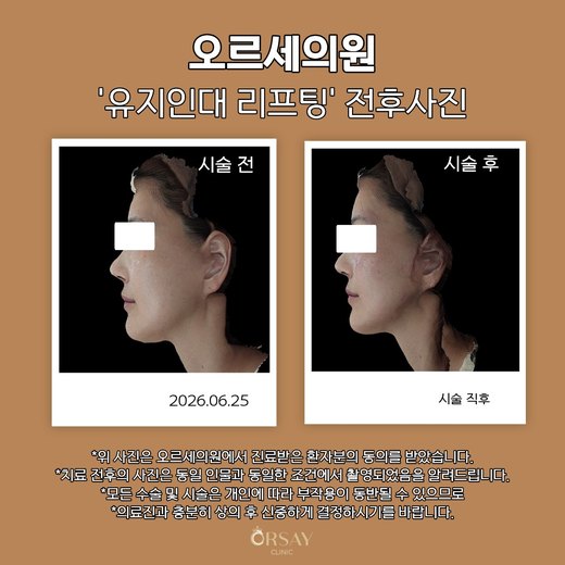 유지인대 리프팅 전후사진 측면