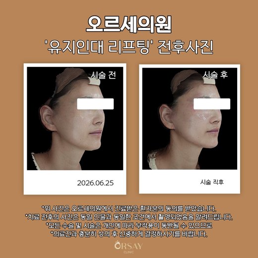 유지인대 리프팅 전후사진 45도
