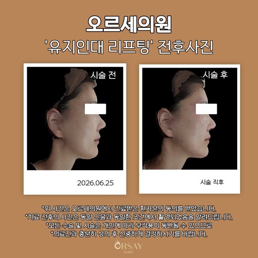 유지인대 리프팅 전후사진 측면