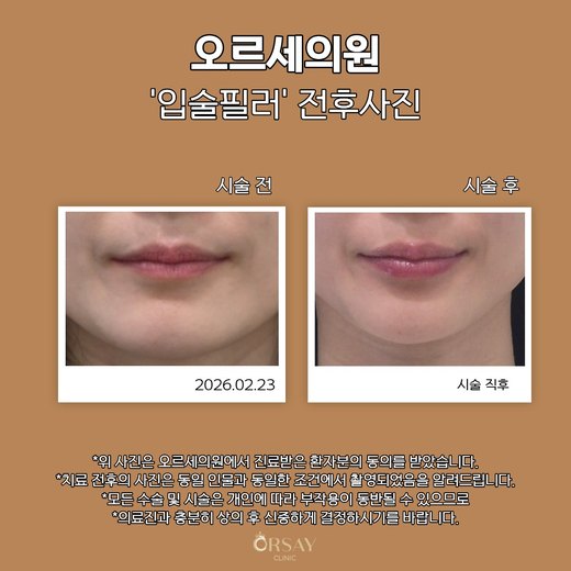 입술필러 시술 전후 정면 사진 (2026.02.23, 시술 직후)