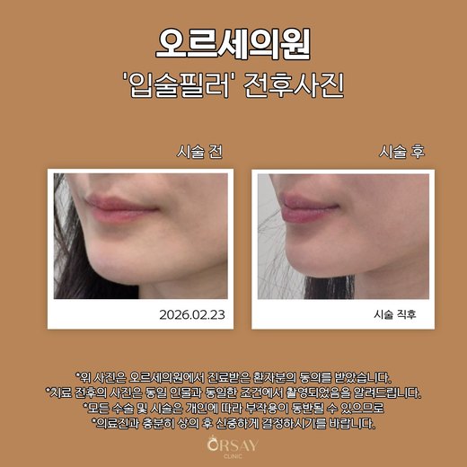 입술필러 시술 전후 45도 왼쪽 사진