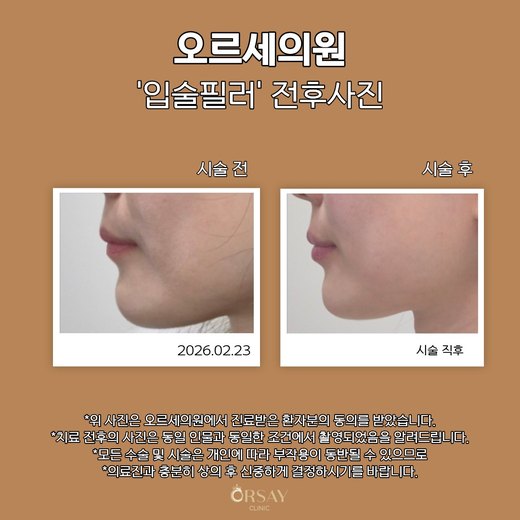 입술필러 시술 전후 90도 측면 사진