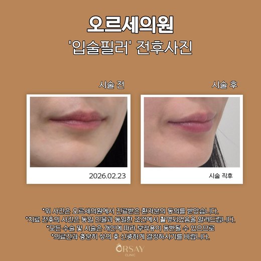 입술필러 시술 전후 45도 오른쪽 사진