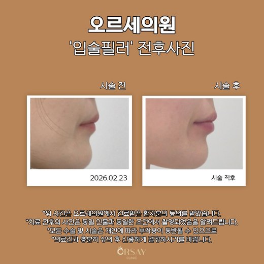 입술필러 시술 전후 90도 오른쪽 사진