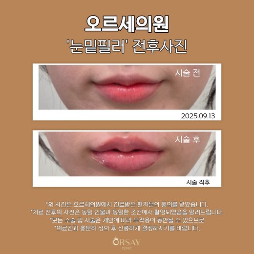 입술필러 재시술 전과 시술 직후 정면 입술 사진 2025.09.13