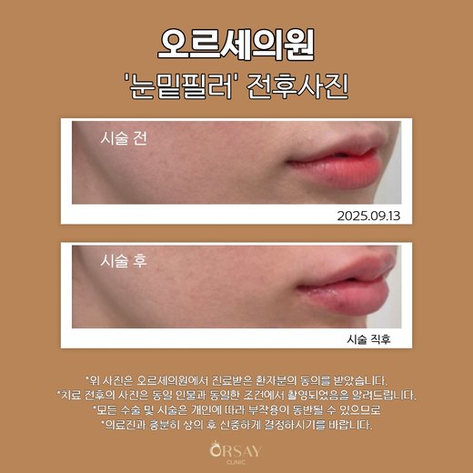 입술필러 재시술 전과 시술 직후 측면 입술 사진 2025.09.13