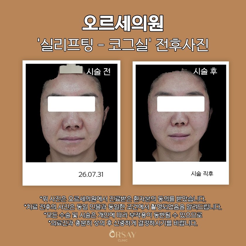 실리프팅 코그실 전후사진 정면 26.07.31
