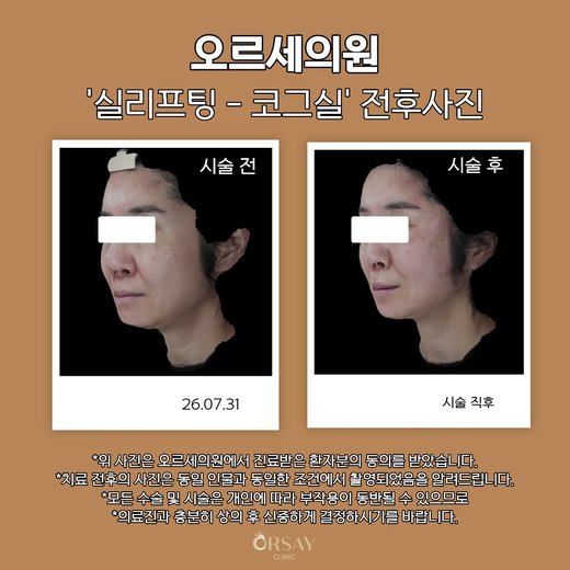 실리프팅 코그실 전후사진 26.07.31
