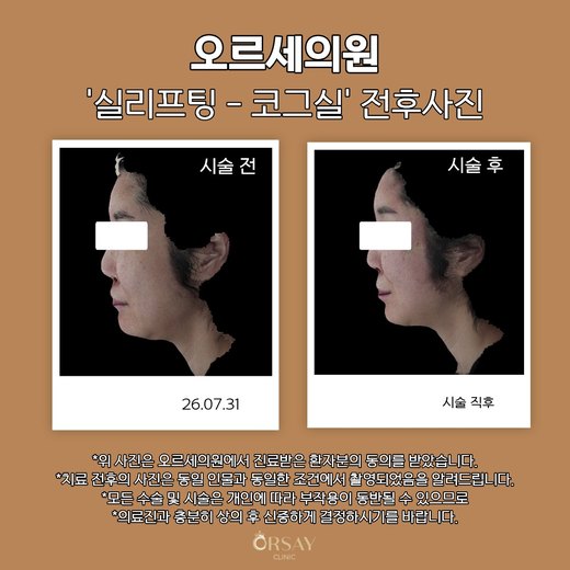 실리프팅 코그실 전후사진 26.07.31