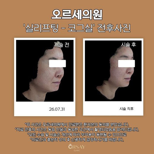 실리프팅 코그실 전후사진 26.07.31