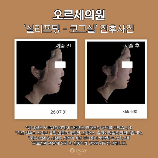 실리프팅 코그실 전후사진 26.07.31