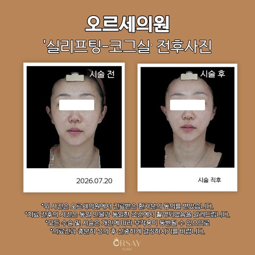 실리프팅 코그실 전후사진 2026.07.20