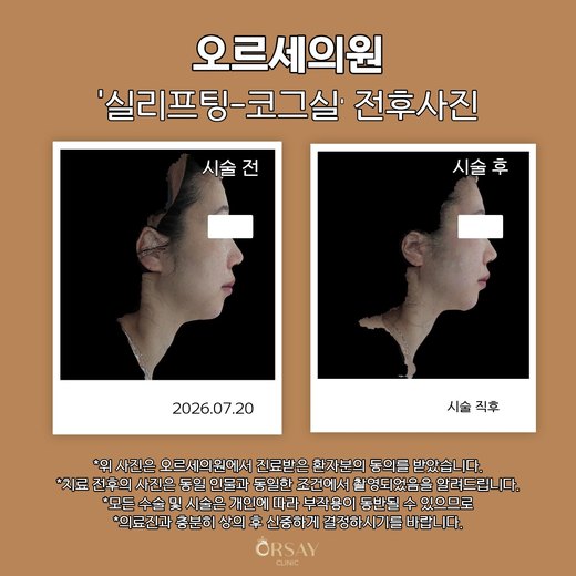 실리프팅 코그실 전후사진 2026.07.20