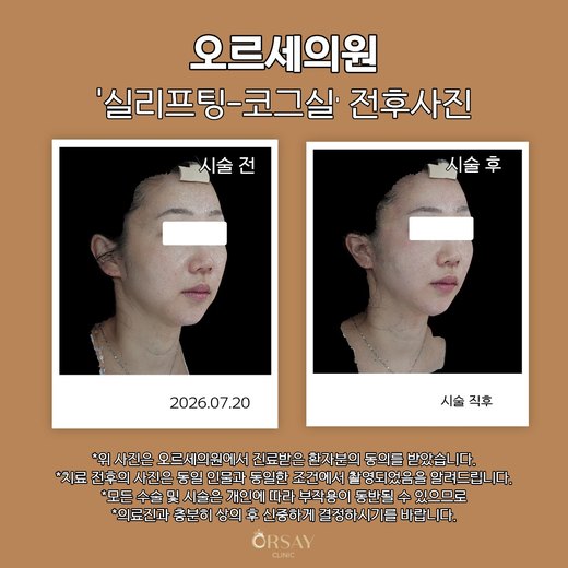 실리프팅 코그실 전후사진 2026.07.20