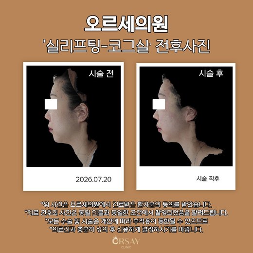 실리프팅 코그실 전후사진 2026.07.20