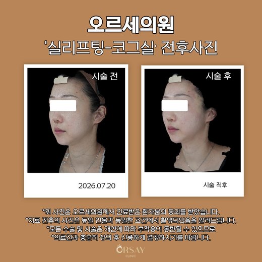 실리프팅 코그실 전후사진 2026.07.20