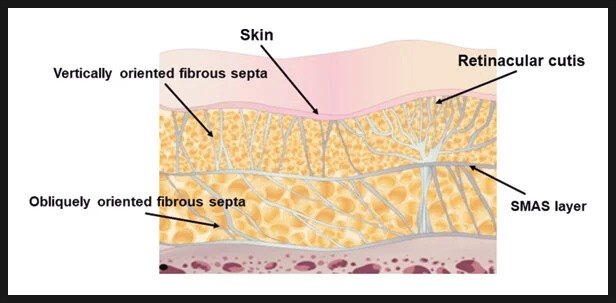 피부(Skin)와 SMAS층 사이 지방층의 수직·사선 방향 섬유성 격막(fibrous septa)과 retinacular cutis를 표시한 피부 단면 그림