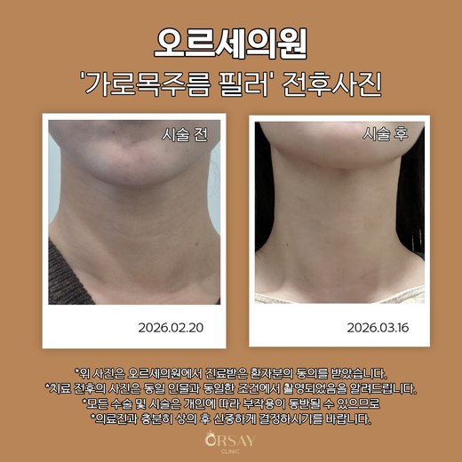 가로목주름 필러 시술 전후 정면 사진 (2026.02.20, 2026.03.16)