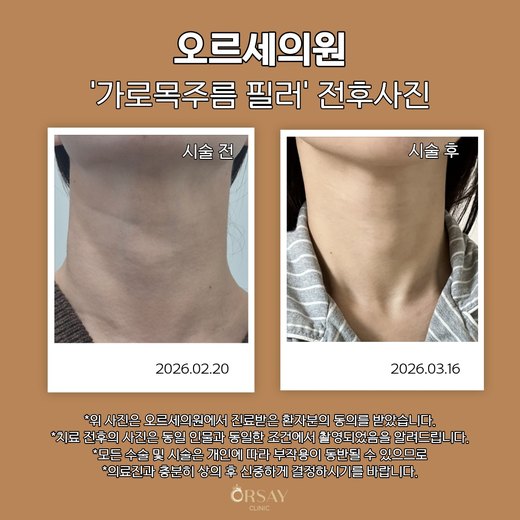 가로목주름 필러 시술 전후 하늘을 보고 찍은 사진