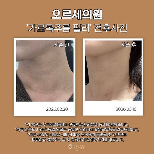 가로목주름 필러 시술 전후 45도 왼쪽 사진