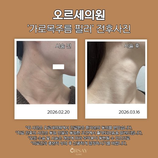 가로목주름 필러 시술 전후 45도 오른쪽 사진