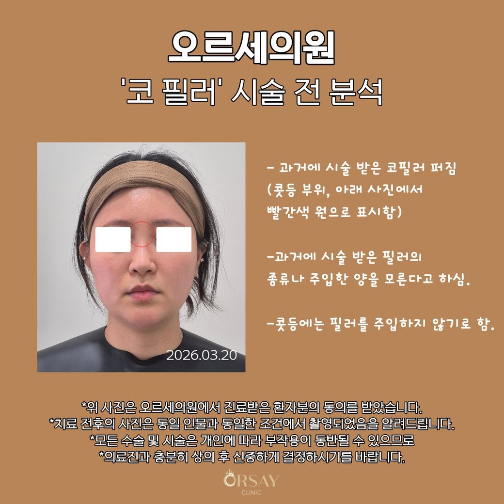 코 필러 시술 전 분석: 과거에 시술 받은 코필러 퍼짐(콧등 부위), 과거에 시술 받은 필러의 종류나 주입한 양을 모른다고 하심, 콧등에는 필러를 주입하지 않기로 함