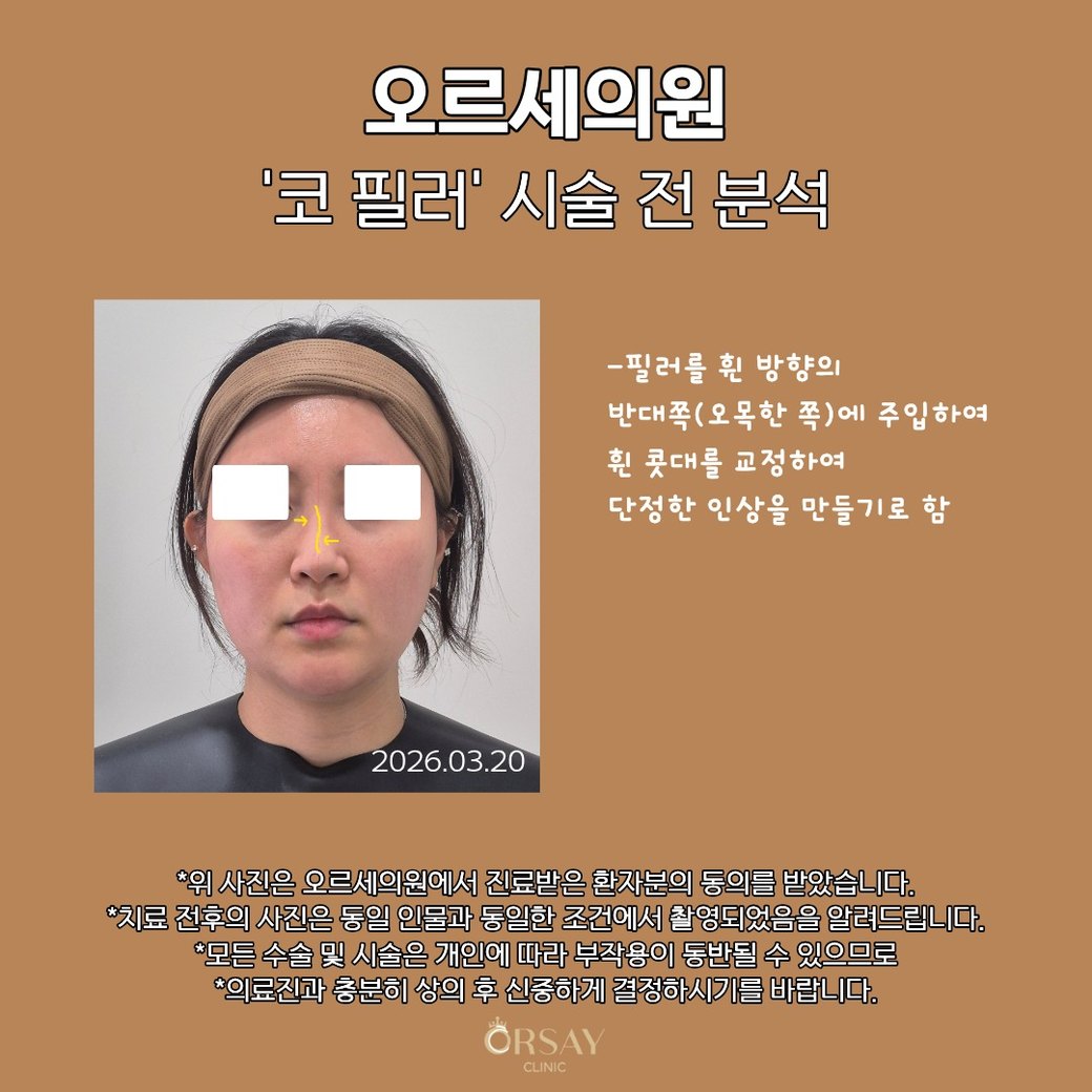 코 필러 시술 전 분석: 필러를 휜 방향의 반대쪽(오목한 쪽)에 주입하여 휜 콧대를 교정하여 단정한 인상을 만들기로 함