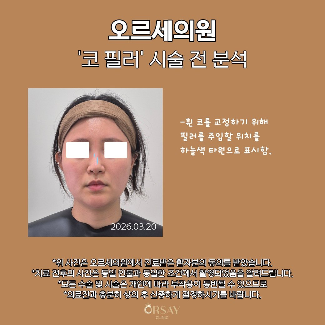 코 필러 시술 전 분석: 휜 코를 교정하기 위해 필러를 주입할 위치를 하늘색 타원으로 표시함