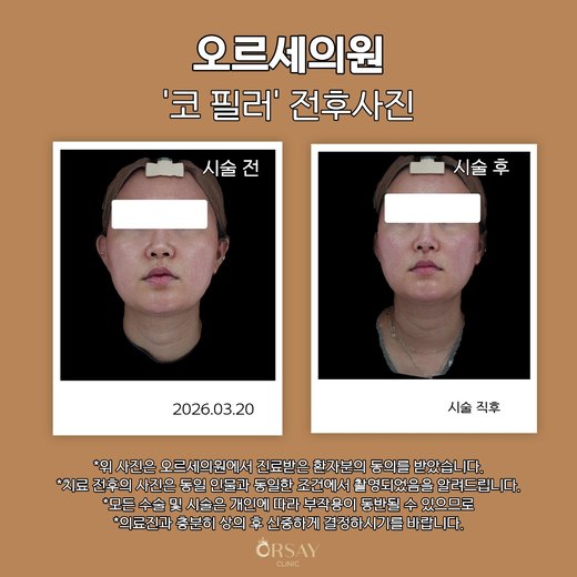 코 필러 시술 전후 정면 사진 (2026.03.20, 시술 직후)