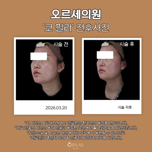 코 필러 시술 전후 왼쪽 45도 사진