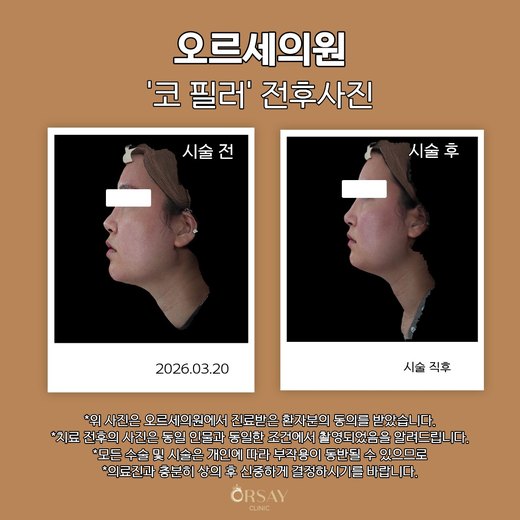 코 필러 시술 전후 왼쪽 90도 사진