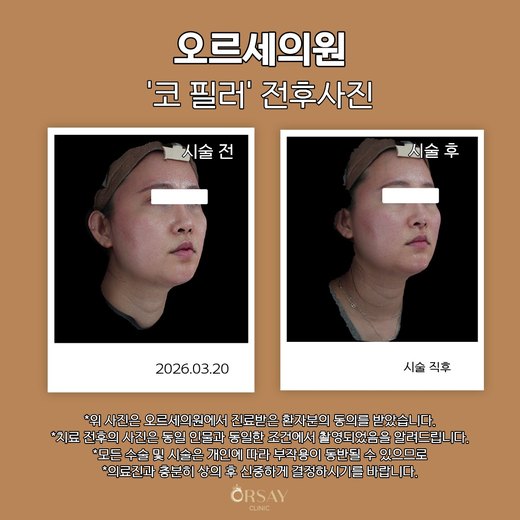 코 필러 시술 전후 오른쪽 45도 사진