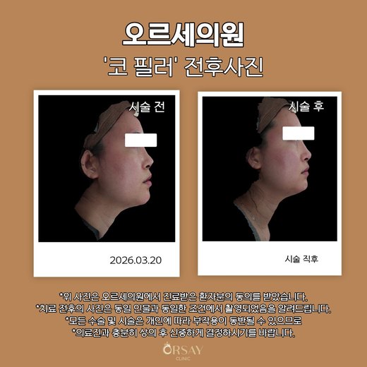코 필러 시술 전후 오른쪽 90도 사진