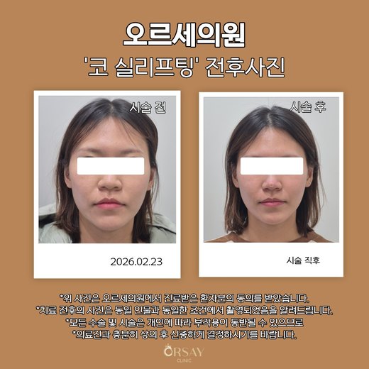 코 실리프팅 전후사진