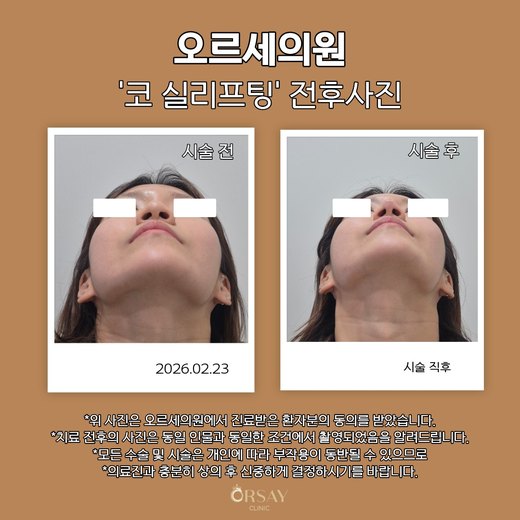 코 실리프팅 전후사진