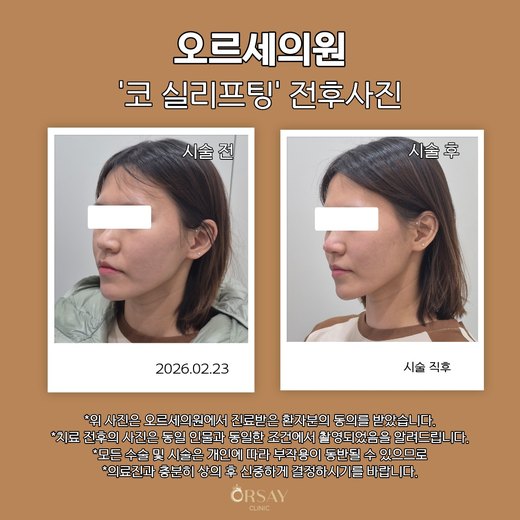 코 실리프팅 전후사진