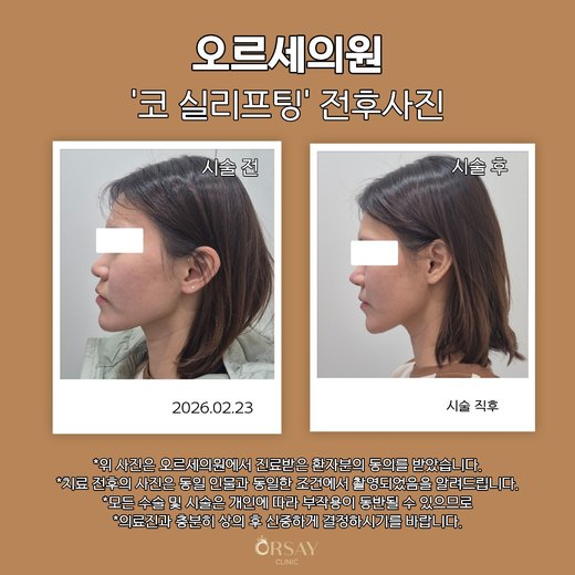 코 실리프팅 전후사진