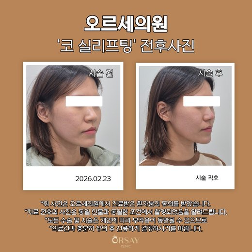 코 실리프팅 전후사진