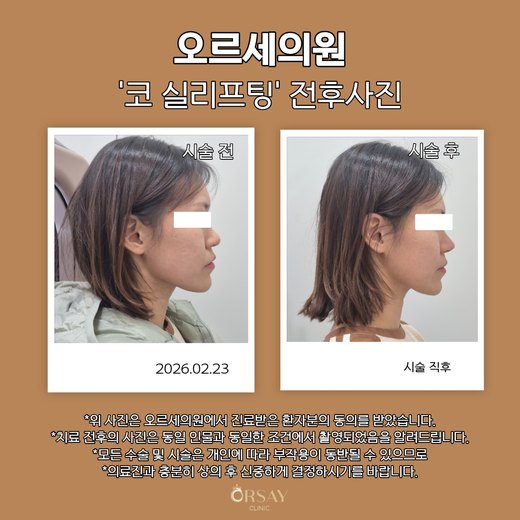 코 실리프팅 전후사진