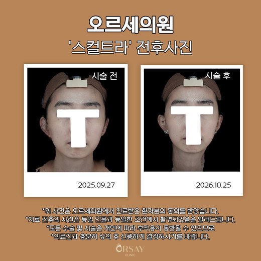 스컬트라 시술 전후 정면 사진