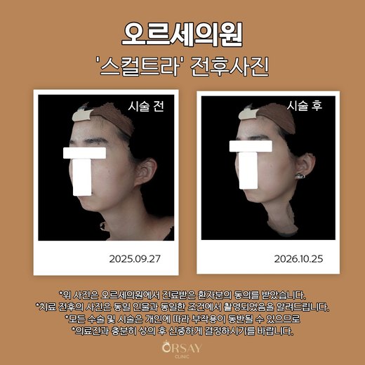 스컬트라 시술 전후 왼쪽 45도 사진
