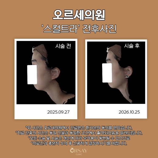 스컬트라 시술 전후 왼쪽 90도 사진