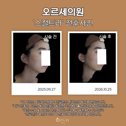 스컬트라 시술 전후 오른쪽 45도 사진