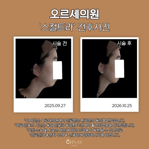 스컬트라 시술 전후 오른쪽 90도 사진