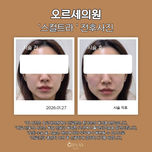 스컬트라 시술 전과 시술 직후 정면 사진 2026.01.27